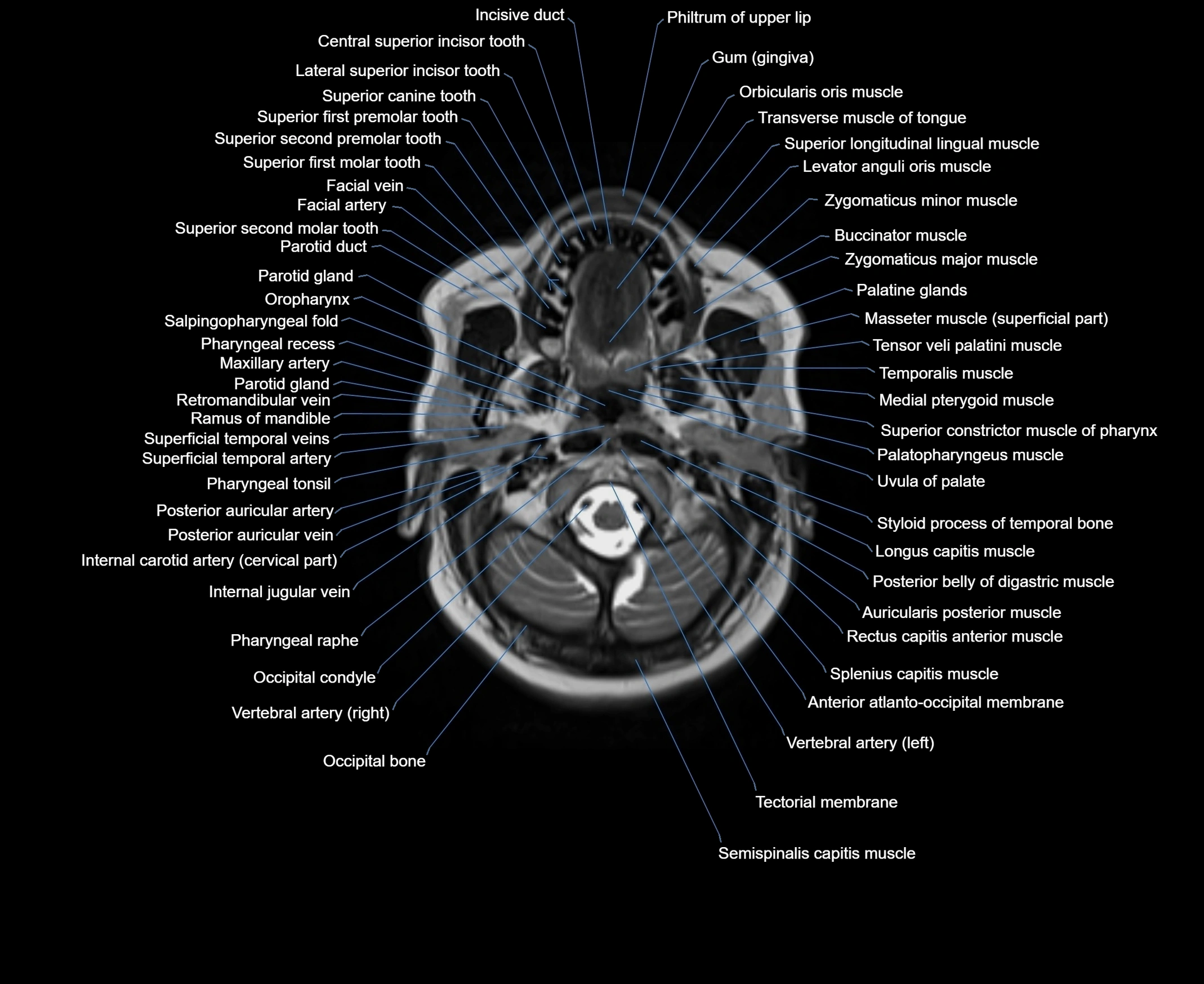 MRI Neck 3D labelled cross section anatomy axial 3t image-00001-00021.webp